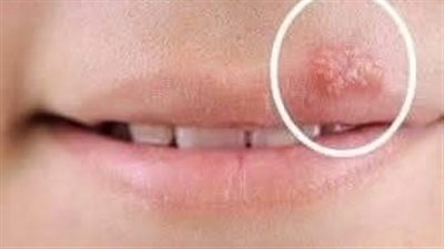 الهيـربس عند الاطفال