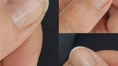 وجود أظافر مخططة قد يعني أن جسمك