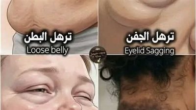 ترهل الجفن بسبب قلة النوم